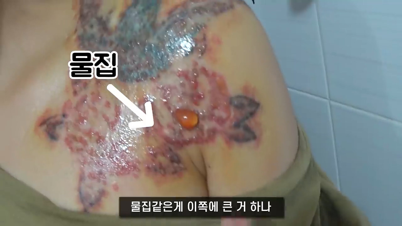 문신 제거 후기 - 꾸르